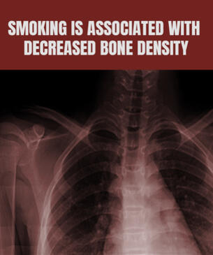 Smoking is associated with decreased bone density: x-ray of a partial human body